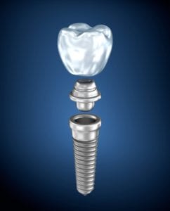 Dental Implants in Owens Cross Roads, Alabama