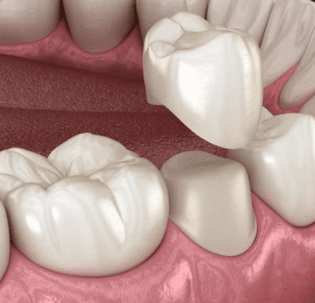 3D render of dental crown hovering over reshaped tooth restorative dentistry dentist in Owen's Cross Roads Alabama