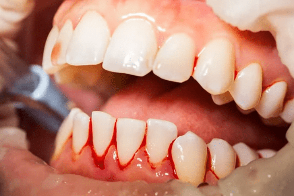 closeup of bleeding gums during dental treatment periodontal disease dentist in Owen's Cross Roads Alabama