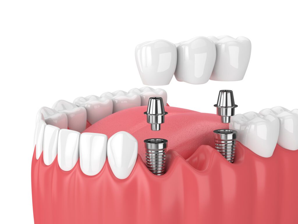 Dental Implant Procedure in Owens Cross Roads, AL