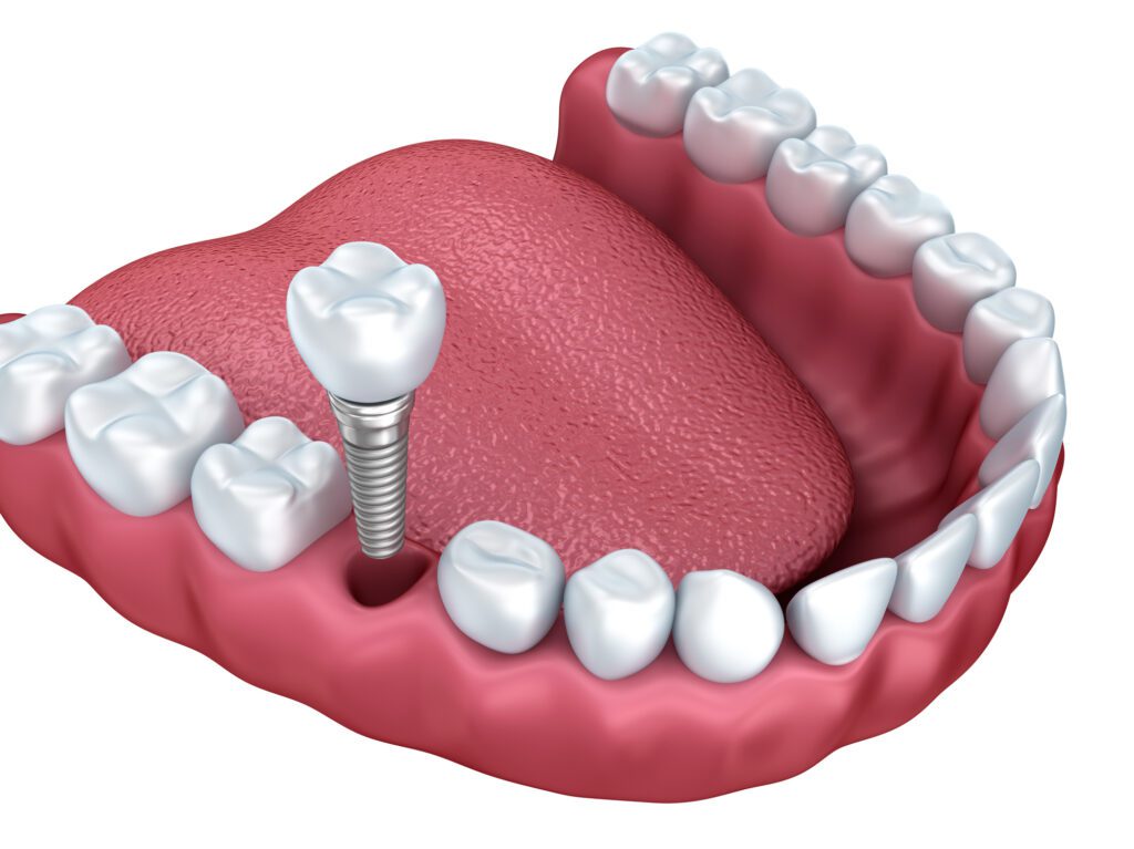 implant supported crowns in Owens Cross Roads, AL