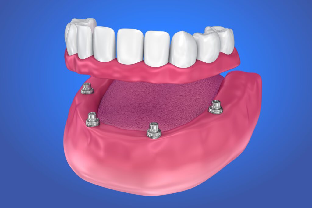 implant-supported denture in Owens Cross Roads, AL