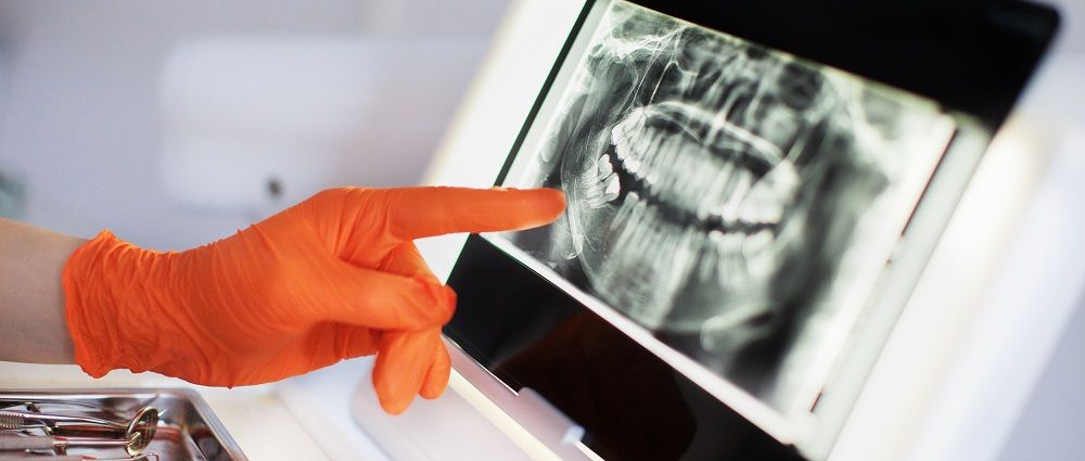Damage of a Tooth Infection